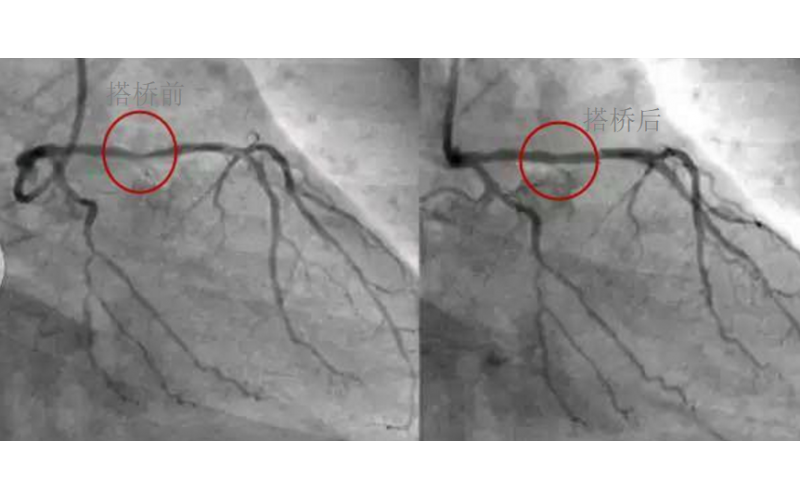 深圳市模具廠對心臟支架的關注，國產化的道路有多長？